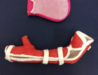 Luva e gesso utilizados na Terapia por Contensão Induzida (TCI) na AACD.